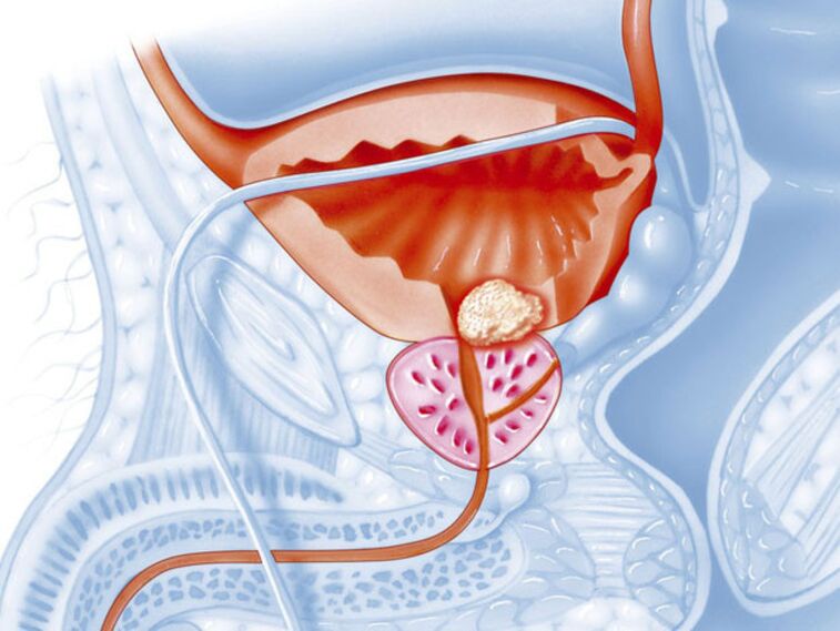 chronic prostatitis symptoms